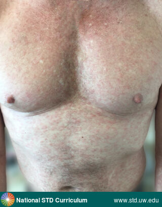 Diagnosis: Syphilis-Secondary, Clinical Signs: Macule / Macules, Rash, Locations: Chest, Light skin tone, Symptoms: N/A, Image Type: Photo