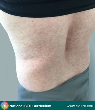 Diagnosis: Syphilis-Secondary, Clinical Signs: Macule / Macules, Rash, Locations: Back, Light skin tone, Symptoms: N/A, Image Type: Photo