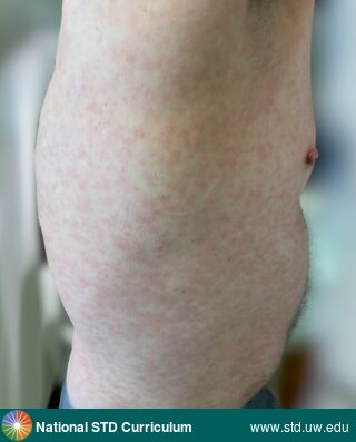 Diagnosis: Syphilis-Secondary, Clinical Signs: Macule / Macules, Rash, Locations: Back, Chest, Light skin tone, Symptoms: N/A, Image Type: Photo