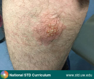 Diagnosis: Herpes simplex virus-2, Clinical Signs: Erythema, Vesicle / Vesicles, Locations: Thigh, Symptoms: N/A, Image Type: Photo