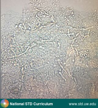 Diagnosis: Tinea versicolor, Clinical Signs: N/A, Locations: Microscope, Symptoms: N/A, Image Type: Photo