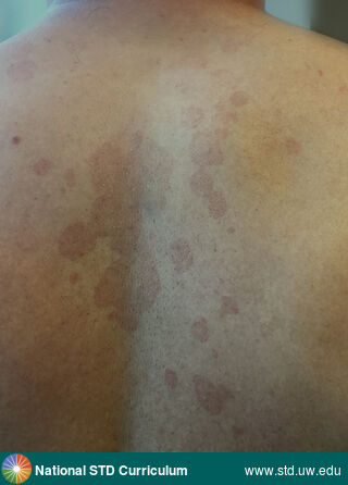 Diagnosis: Tinea versicolor, Clinical Signs: Erythema, Hyperpigmentation, Rash, Scale, Locations: Back, Symptoms: N/A, Image Type: Photo