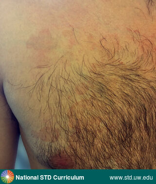 Diagnosis: Tinea versicolor, Clinical Signs: Erythema, Hyperpigmentation, Rash, Locations: Chest, Symptoms: N/A, Image Type: Photo