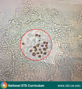 Diagnosis: Pityriasis versicolor, Clinical Signs: N/A, Locations: Light skin tone, Symptoms: N/A, Image Type: Photo