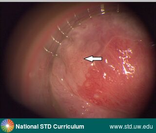 Diagnosis: Anal Precancer (Dysplasia/LSIL/HSIL), Clinical Signs: N/A, Locations: Microscope, Symptoms: N/A, Image Type: Photo