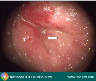 Diagnosis: Anal Precancer (Dysplasia/LSIL/HSIL), Clinical Signs: Plaque, Locations: Anal / Intra-anal, Symptoms: N/A, Image Type: Photo