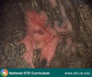 Diagnosis: Anal Cancer, Clinical Signs: Lesion, Locations: Anal / Intra-anal, Anal / Perianal, Dark skin tone, Symptoms: N/A, Image Type: Photo