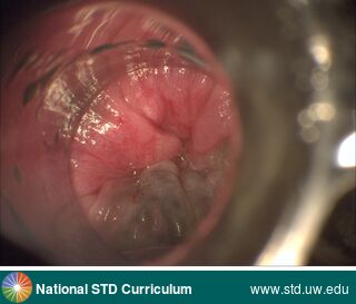 Diagnosis: Anal Cancer, Clinical Signs: N/A, Locations: Anal / Intra-anal, Anal / Perianal, Dark skin tone, Symptoms: N/A, Image Type: Photo