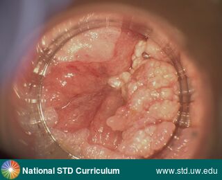 Diagnosis: Warts (Anogenital), Clinical Signs: Verrucous, Locations: Anal / Intra-anal, Symptoms: N/A, Image Type: Photo