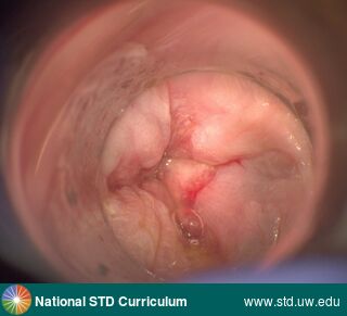 Diagnosis: Warts (Anogenital), Clinical Signs: Verrucous, Locations: Anal / Intra-anal, Symptoms: N/A, Image Type: Photo