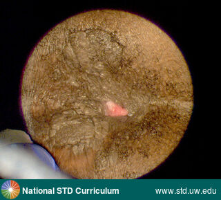 Diagnosis: Warts (Anogenital), Clinical Signs: Papule / Papules, Verrucous, Locations: Anal / Perianal, Dark skin tone, Symptoms: N/A, Image Type: Photo