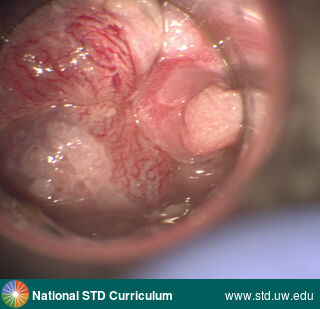 Diagnosis: Warts (Anogenital), Clinical Signs: Verrucous, Locations: Anal / Intra-anal, Symptoms: N/A, Image Type: Photo