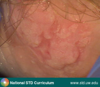 Diagnosis: Anal Precancer (Dysplasia/LSIL/HSIL), Clinical Signs: Plaque, Locations: Anal / Perianal, Symptoms: N/A, Image Type: Photo