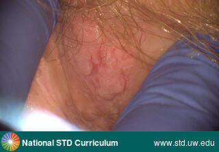 Diagnosis: Anal Precancer (Dysplasia/LSIL/HSIL), Clinical Signs: Plaque, Locations: Anal / Perianal, Symptoms: N/A, Image Type: Photo