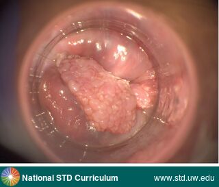 Diagnosis: Warts (Anogenital), Clinical Signs: Mass, Verrucous, Locations: Anal / Intra-anal, Symptoms: N/A, Image Type: Photo
