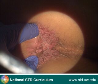 Diagnosis: Warts (Anogenital), Clinical Signs: Verrucous, Locations: Anal / Perianal, Symptoms: N/A, Image Type: Photo