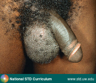 Diagnosis: Epididymitis, Clinical Signs: N/A, Locations: Dark skin tone, Scrotum, Symptoms: N/A, Image Type: Photo