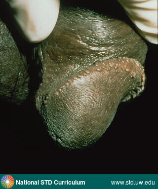 Diagnosis: Pearly penile papules, Clinical Signs: N/A, Locations: Dark skin tone, Penis, Symptoms: N/A, Image Type: Photo
