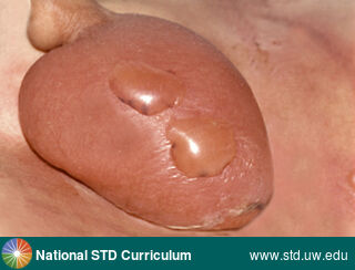 Diagnosis: Necrotizing Fasciitis (Fournier's gangrene), Clinical Signs: Bulla / Bullae, Edema / Swelling, Erythema, Locations: Light skin tone, Scrotum, Symptoms: Painful, Image Type: Photo