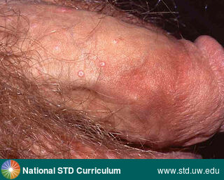 Diagnosis: Molluscum, Clinical Signs: Papule / Papules, Locations: Light skin tone, Penis, Symptoms: Non-Painful, Image Type: Photo