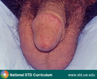 Diagnosis: Scabies, Clinical Signs: Erythema, Papule / Papules, Rash, Locations: Light skin tone, Penis, Symptoms: Itch, Non-Painful, Image Type: Photo