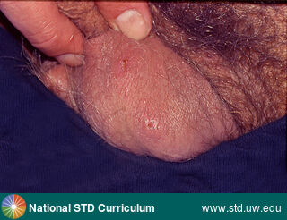 Diagnosis: Scabies, Clinical Signs: Papule / Papules, Rash, Locations: Light skin tone, Scrotum, Symptoms: Itch, Non-Painful, Image Type: Photo