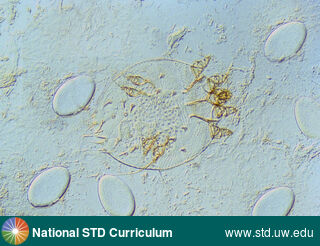 Diagnosis: Scabies, Clinical Signs: N/A, Locations: Microscope, Symptoms: N/A, Image Type: Photo