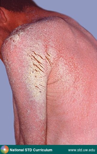 Diagnosis: Scabies, Clinical Signs: Plaque, Rash, Scale, Locations: Back, Shoulder (Left), Shoulder (Right), Symptoms: Non-Itchy, Rash, Image Type: Photo