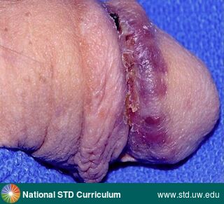 Diagnosis: Kaposi sarcoma, Clinical Signs: Lesion, Plaque, Locations: Light skin tone, Penis, Symptoms: Non-Itchy, Non-Painful, Image Type: Photo