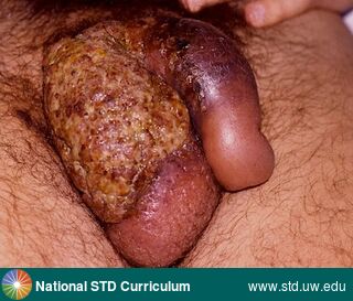 Diagnosis: Kaposi sarcoma, Clinical Signs: Edema / Swelling, Lesion, Mass, Plaque, Locations: Penis, Scrotum, Symptoms: N/A, Image Type: Photo