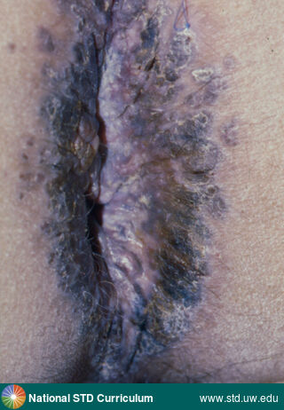 Diagnosis: Anal Cancer, Clinical Signs: Lesion, Plaque, Locations: Anal / Perianal, Dark skin tone, Symptoms: Painful, Image Type: Photo