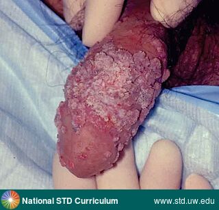 Diagnosis: Warts (Anogenital), Clinical Signs: Verrucous, Locations: Light skin tone, Penis, Symptoms: Non-Painful, Image Type: Photo