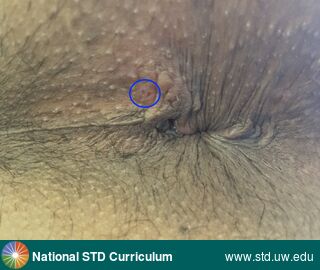 Diagnosis: HSV-type unknown, Clinical Signs: Ulcer / Ulcers, Locations: Anal / Perianal, Symptoms: N/A, Image Type: Photo