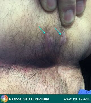 Diagnosis: Syphilis-Secondary, Clinical Signs: Papule / Papules, Plaque, Locations: Anal / Perianal, Light skin tone, Tonsil, Symptoms: Non-Painful, Image Type: Photo