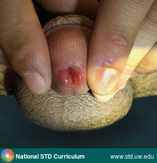 Diagnosis: Herpes simplex virus-1, Clinical Signs: Ulcer / Ulcers, Locations: Light skin tone, Penis, Symptoms: Dysuria, Image Type: Photo