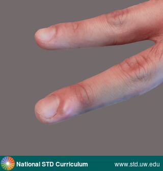 Diagnosis: Herpes simplex virus-1, Clinical Signs: Edema / Swelling, Vesicle / Vesicles, Locations: Hand (Left), Light skin tone, Symptoms: Non-Itchy, Painful, Image Type: Photo