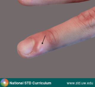 Diagnosis: Herpes-Digital (Whitlow), Herpes-Genital, Clinical Signs: Vesicle / Vesicles, Locations: Hand (Left), Light skin tone, Symptoms: Non-Itchy, Painful, Image Type: Photo