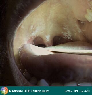 Diagnosis: Candidiasis-Oral, Clinical Signs: Plaque, Locations: Dark skin tone, Palate, Pharynx, Symptoms: N/A, Image Type: Photo