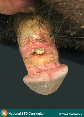 Diagnosis: Contact Dermatitis - Irritant, Warts (Anogenital), Clinical Signs: Erythema, Verrucous, Locations: Light skin tone, Penis, Symptoms: N/A, Image Type: Photo