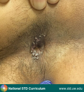 Diagnosis: Warts (Anogenital), Clinical Signs: Papule / Papules, Verrucous, Locations: Anal / Intra-anal, Anal / Perianal, Dark skin tone, Symptoms: Non-Itchy, Non-Painful, Image Type: Photo