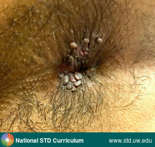Diagnosis: Warts (Anogenital), Clinical Signs: Papule / Papules, Verrucous, Locations: Anal / Perianal, Dark skin tone, Symptoms: Non-Itchy, Non-Painful, Image Type: Photo