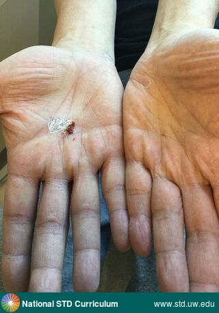 Diagnosis: Syphilis-Secondary, Clinical Signs: Papule / Papules, Plaque, Locations: Hand (Right), Symptoms: N/A, Image Type: Photo