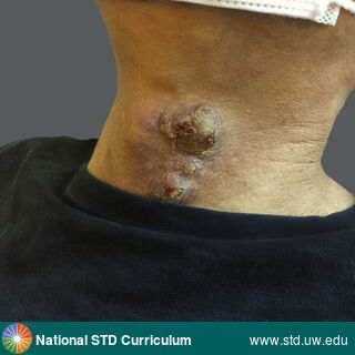 Diagnosis: Syphilis-Secondary, Clinical Signs: Edema / Swelling, Lesion, Nodule / Nodules, Locations: Light skin tone, Neck, Symptoms: N/A, Image Type: Photo