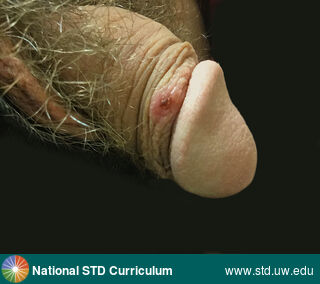 Diagnosis: Syphilis-Primary, Clinical Signs: Erythema, Lesion, Scab, Ulcer / Ulcers, Locations: Light skin tone, Penis, Symptoms: Non-Painful, Image Type: Photo