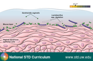 Diagnosis: Bacterial vaginosis (BV), Clinical Signs: N/A, Locations: N/A, Symptoms: N/A, Image Type: Illustration