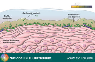 Diagnosis: Bacterial vaginosis (BV), Clinical Signs: N/A, Locations: N/A, Symptoms: N/A, Image Type: Illustration