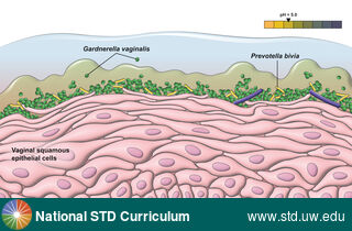 Diagnosis: Bacterial vaginosis (BV), Clinical Signs: N/A, Locations: N/A, Symptoms: N/A, Image Type: Illustration