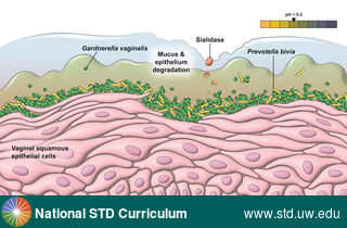 Diagnosis: Bacterial vaginosis (BV), Clinical Signs: N/A, Locations: N/A, Symptoms: N/A, Image Type: Illustration