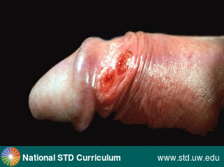 Diagnosis: Syphilis-Primary, Clinical Signs: Erythema, Ulcer / Ulcers, Locations: Penis, Symptoms: N/A, Image Type: Photo