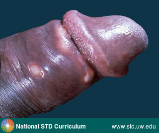 Diagnosis: Syphilis-Primary, Clinical Signs: Scale, Ulcer / Ulcers, Locations: Dark skin tone, Penis, Symptoms: N/A, Image Type: Photo